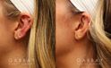 Patient 04 Left Side View Earlobe Repair Gabbay Plastic Surgery