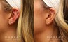 Patient 04 Left Side View Earlobe Repair Gabbay Plastic Surgery