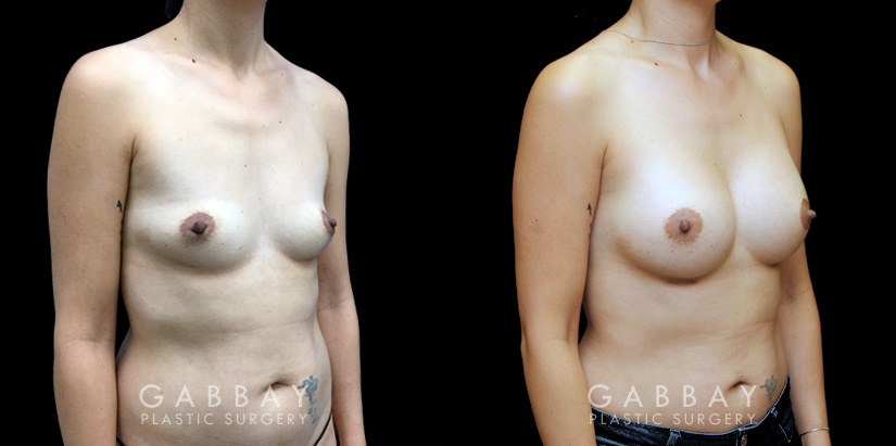 Procedures Depicted:  Breast Augmentation – Silicone