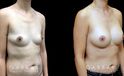 Procedures Depicted:  Breast Augmentation – Silicone