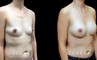 Procedures Depicted:  Breast Augmentation – Silicone