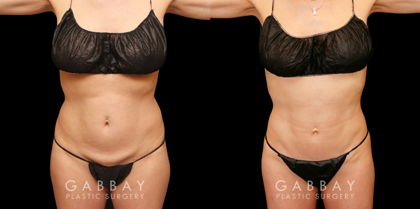 Procedures Depicted:  Liposuction to back bulge Patient with combined abdominal liposuction with liposuction targeting stubborn fat bulges on her back. The combined procedure restored a youthful figure and slimmed contours.