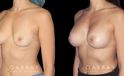 Breast augmentation before-and-after photos for female patient. Final results healed well, matching her body shape and contour well.