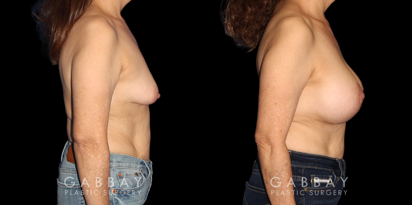 Procedures Depicted:  Breast Augmentation w/ Mastopexy – Silicone