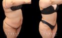 Tummy tuck patient photos from before and after the procedure. On the left, patient shows loose skin and significant banding/rolling of the skin. After the surgery, patient has tightened skin on all angles and note the absence of overhanging skin even when leaning forward.