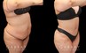 Tummy tuck patient photos from before and after the procedure. On the left, patient shows loose skin and significant banding/rolling of the skin. After the surgery, patient has tightened skin on all angles and note the absence of overhanging skin even when leaning forward.