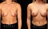 This patient had significant weight loss over time and wanted to have a more full and lifted breast look. She had Allergan Natrelle, soft touch, moderate profile implants placed (310 cc), and then underwent a breast lift to address the droop. She was happy with her soft, natural breast shape, and the dramatic change it made to her overall torso appearance.