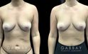 Patient 14 Front View Breast Fat Grafting Gabbay Plastic Surgery