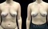 Patient 14 Front View Breast Fat Grafting Gabbay Plastic Surgery