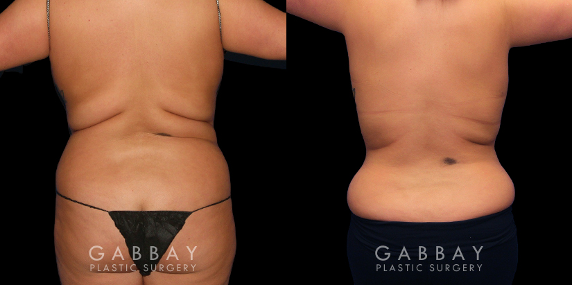 Procedures Depicted:  Lipo to flanks, front and back bra roll with transfer to breast