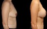 Scar revision to breasts results with additional breast augmentation and lift combination. Patient improved breast size and position with mild scarring only.