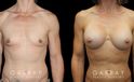 Breast augmentation results for patient with slim and fit body type. The silicone implants were chosen to match this tighter physique for a natural balance.