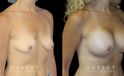 Patient in her mid 40s following breast augmentation. Before-and-after photos show her fully healed results from each angle, demonstrating the improved breast volume.