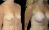 Patient in her mid 40s following breast augmentation. Before-and-after photos show her fully healed results from each angle, demonstrating the improved breast volume.