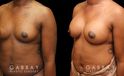 Patient before and after receiving silicone implants to increase breast roundness and overall volume. Results are shown following complete, smoother recovery.