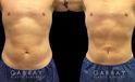 Male patient after abdominal liposuction, improving the patient’s torso shape and resulting in a more masculine contour from each angle with a flat abdomen. Compare to the sloping belly roundness before.