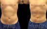 Male patient after abdominal liposuction, improving the patient’s torso shape and resulting in a more masculine contour from each angle with a flat abdomen. Compare to the sloping belly roundness before.