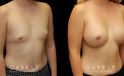 Patient results for breast augmentation with silicone implants. Before there was minimal breast volume, with the results increasing size without damaging the skin around the breasts. Note the lack of visible scarring.