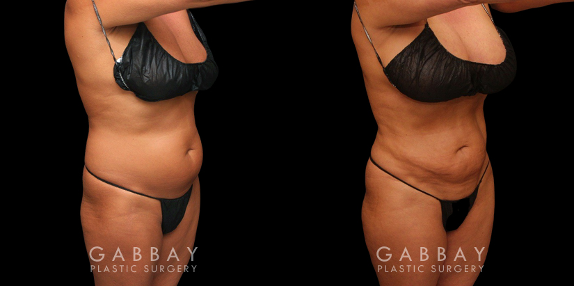 Procedures Depicted:  liposuction and j plasma to full abdomen Female African-American patient after liposuction and J plasma treatment to her full abdomen, reducing her bulging belly and to tighten and restore loose skin.