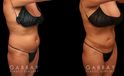 Procedures Depicted:  liposuction and j plasma to full abdomen Female African-American patient after liposuction and J plasma treatment to her full abdomen, reducing her bulging belly and to tighten and restore loose skin.