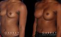 Patient results following recovery of breast augmentation using silicone implants. Note the increase in sense of fullness despite only boosting volume a restrained amount.