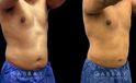 Male patient after surgical removal of abdominal fat. His liposuction results emphasize the naturally masculine form of his torso with a tighter figure overall.