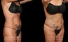 Liposuction before-and-after for female patient who wanted subtle fat removal around the lower abdomen to target stubborn belly fat. Her results show a decrease in lower abdominal bulge for a flatter contour.