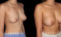Female patient in her 20s before-and-after revision breast augmentation, including implant removal and replacement with additional breast lift to improve breast position.