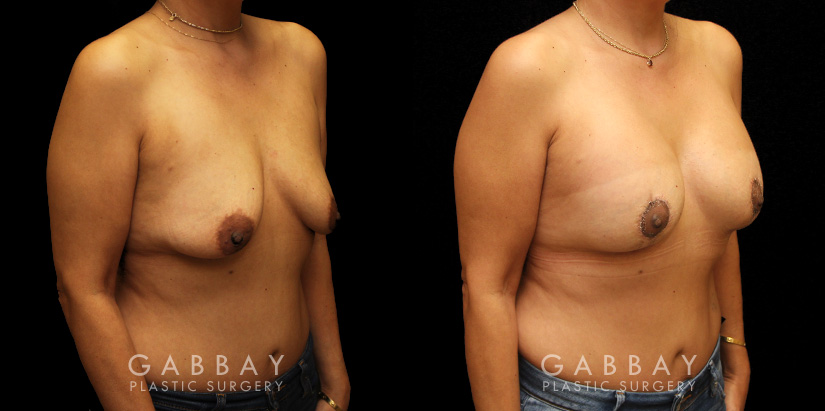 Procedures Depicted:  Breast Aug/Pexy