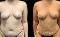Patient 04 Front View Breast Fat Grafting Gabbay Plastic Surgery