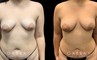 Patient 04 Front View Breast Fat Grafting Gabbay Plastic Surgery