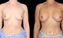 Smoother recovery for patient who chose silicone implants for breast augmentation. Breast position was maintained to keep a natural look that enhances her body type’s contours.