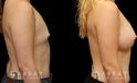 Patient results for breast augmentation with silicone implants. Before there was minimal breast volume, with the results increasing size without damaging the skin around the breasts. Note the lack of visible scarring.