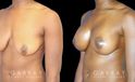 Silicone breast augmentation before-and-after photos demonstration enhanced breast size. Patient combined augmentation with a breast lift for improved breast position as well.
