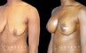 Silicone breast augmentation before-and-after photos demonstration enhanced breast size. Patient combined augmentation with a breast lift for improved breast position as well.
