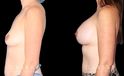 Breast augmentation with increased volume. Note also the improvement to nipple appearance through careful placement of the implants, thus tightening the skin around the nipple for a more aesthetic appearance.
