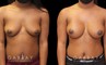 Before-and-after breast augmentation showing improved volume while keeping a natural look to how the breasts lie on the chest.