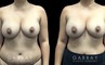 Patient 13 Front View Breast Fat Grafting Gabbay Plastic Surgery