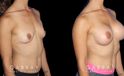 Patient recovered without complication and maintained a round, pleasing shape to her breasts. Scarring is hidden in the breasts natural folds, displaying only her positive results.