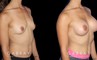 Patient recovered without complication and maintained a round, pleasing shape to her breasts. Scarring is hidden in the breasts natural folds, displaying only her positive results.