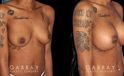 Patient with significant breast volume increase through breast augmentation with silicone implants. Profile view demonstrates the enhanced breast size by silhouette with an alluring, round shape.