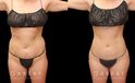 With precise liposuction for the sides, abdomen, and waist, this patient was able to restore her youthful figure and body shape, and achieved virtually no belly fat pockets bulging over the pants line.