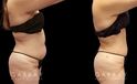 Abdominal liposuction results for a Caucasian patient who wanted to address pockets of belly fat that would not go away. The procedure removed the fat and produced a flat profile with a tighter tummy appearance.