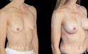 Female patient in her late 40s with breast augmentation results using silicone implants. Patient healed well and achieved a breast size and appearance that enhances a youthful contour and appearance.