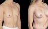 Female patient in her late 40s with breast augmentation results using silicone implants. Patient healed well and achieved a breast size and appearance that enhances a youthful contour and appearance.