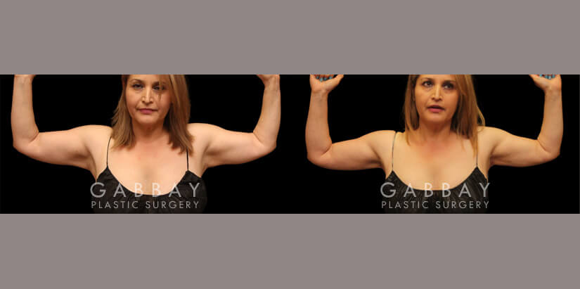 Patient 04 Back View Crecent Arm Lift, Liposuction to Arms, J Plasma to Arms Gabbay Plastic Surgery