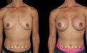 Patient recovered without complication and maintained a round, pleasing shape to her breasts. Scarring is hidden in the breasts natural folds, displaying only her positive results.