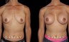 Patient recovered without complication and maintained a round, pleasing shape to her breasts. Scarring is hidden in the breasts natural folds, displaying only her positive results.