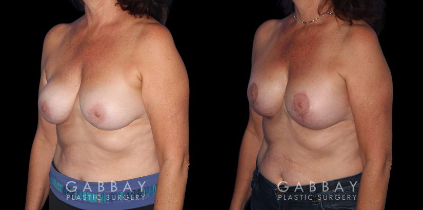 Procedures Depicted:  R&R + Breast Lift