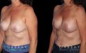 Procedures Depicted:  R&R + Breast Lift